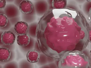 Un ensayo estudiará si las células madre del propio paciente pueden mejorar la cirugía de las metástasis hepáticas por cáncer de colon Un ensayo estudiará si las células madre del propio paciente pueden mejorar la cirugía de las metástasis hepáticas por cáncer de colon