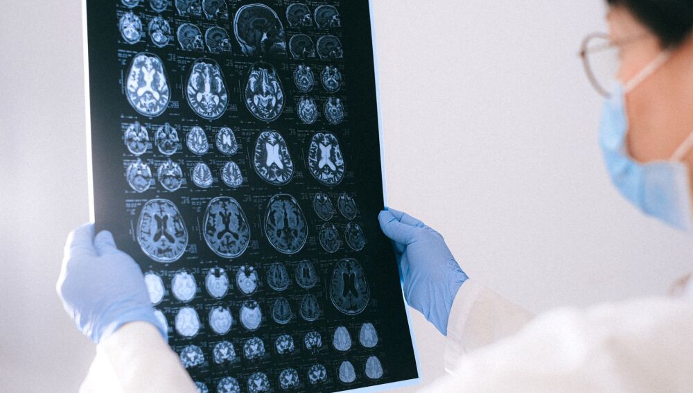 Investigadores identifican posibles dianas terapéuticas para el glioma de alto grado en jóvenes