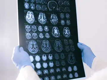 Investigadores identifican posibles dianas terapéuticas para el glioma de alto grado en jóvenes Investigadores identifican posibles dianas terapéuticas para el glioma de alto grado en jóvenes
