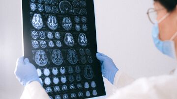 Investigadores identifican posibles dianas terap&eacute;uticas para el glioma de alto grado en j&oacute;venes