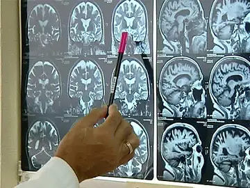 Día Mundial del Alzheimer Día Mundial del Alzheimer