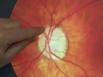 Captura glaucoma Captura glaucoma