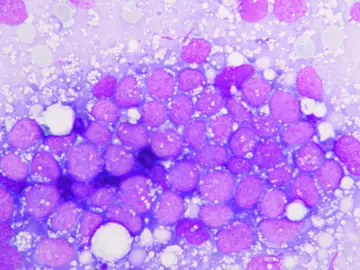 Una muestra de leucemia Una muestra de leucemia