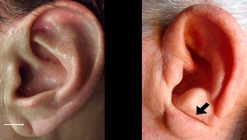 Un pliegue diagonal en la oreja, podría ser un factor de riesgo a la hora de padecer infarto o de ictus 