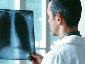 Progresos médicos para combatir el cáncer de pulmón 