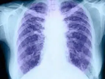 El cáncer de pulmón El cáncer de pulmón