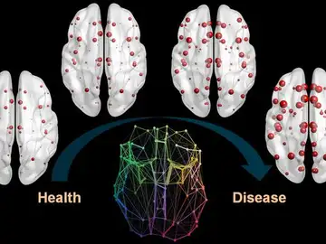 Las proteínas vinculadas al alzhéimer se propagan en el cerebro como una epidemia Las proteínas vinculadas al alzhéimer se propagan en el cerebro como una epidemia