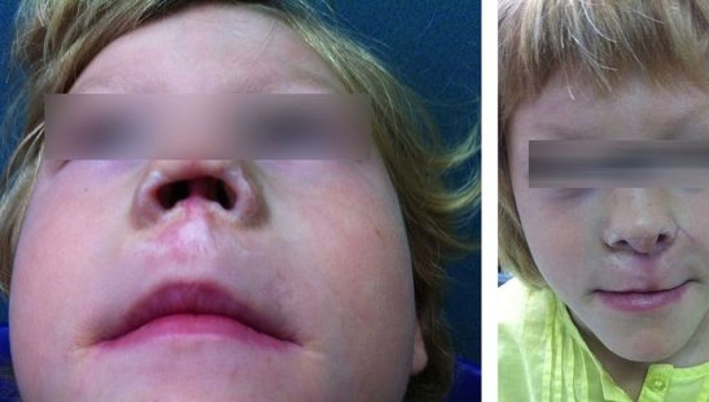 Reconstruyen la nariz de una niña a partir del cartílago y piel de su oreja
