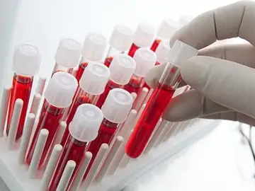 Un test pionero permitirá decidir el mejor tratamiento en casos de cáncer colorrectal metastásico Un test pionero permitirá decidir el mejor tratamiento en casos de cáncer colorrectal metastásico