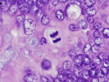 Investigan la mutación BRCA1 y BRCA2 en cáncer de ovario y mama Investigan la mutación BRCA1 y BRCA2 en cáncer de ovario y mama