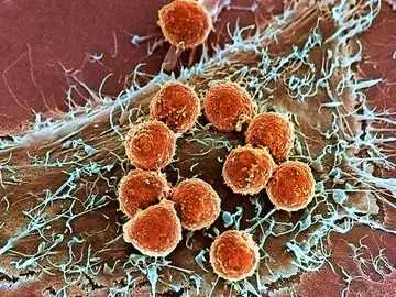 Nuevos tratamientos podrían mejorar la inmunoterapia del cáncer Nuevos tratamientos podrían mejorar la inmunoterapia del cáncer