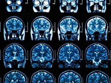 Desarollan nuevo anticuerpo para tratar la lesión cerebral traumática Desarollan nuevo anticuerpo para tratar la lesión cerebral traumática