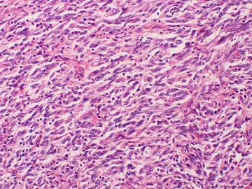 Melanoma Melanoma
