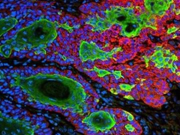 Nanopartículas contra el cáncer