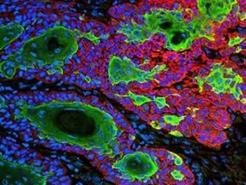 Nanopartículas contra el cáncer Nanopartículas contra el cáncer