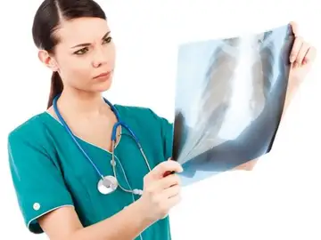 Cáncer de pulmón Cáncer de pulmón