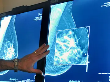 Un test al diagnosticar el cáncer de mama predice cómo irá el tratamiento Un test al diagnosticar el cáncer de mama predice cómo irá el tratamiento