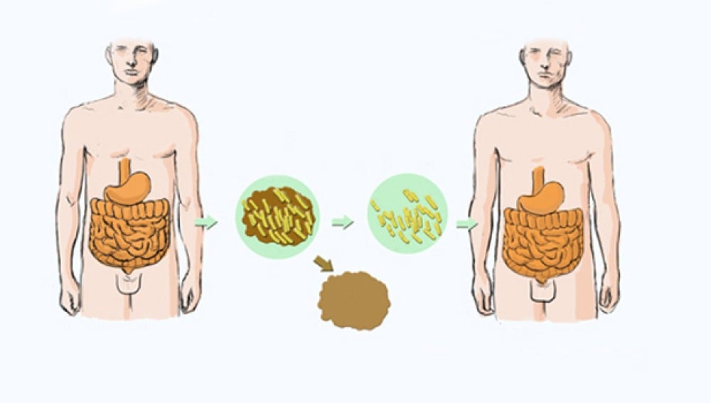 na nueva técnica podría mejorar el trasplante de microbiota intestinal 