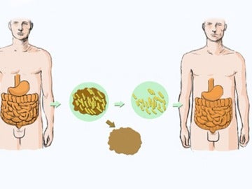 na nueva técnica podría mejorar el trasplante de microbiota intestinal 