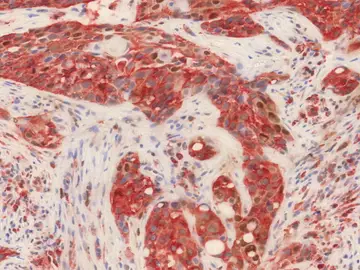 Científicos del CNIO hallan nuevos marcadores tumorales para pronositicar el cáncer de cabeza y cuello Científicos del CNIO hallan nuevos marcadores tumorales para pronositicar el cáncer de cabeza y cuello