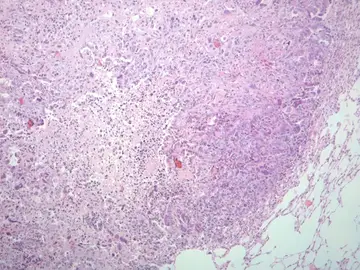 Investigadores del CNIO consiguen reducir el cáncer de pulmón más agresivo Investigadores del CNIO consiguen reducir el cáncer de pulmón más agresivo