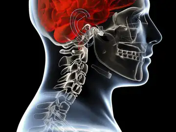 Meningioma Meningioma