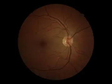 Glaucoma Glaucoma