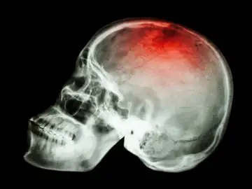 Identifican unos genes asociados con los accidentes cerebrovasculares Identifican unos genes asociados con los accidentes cerebrovasculares