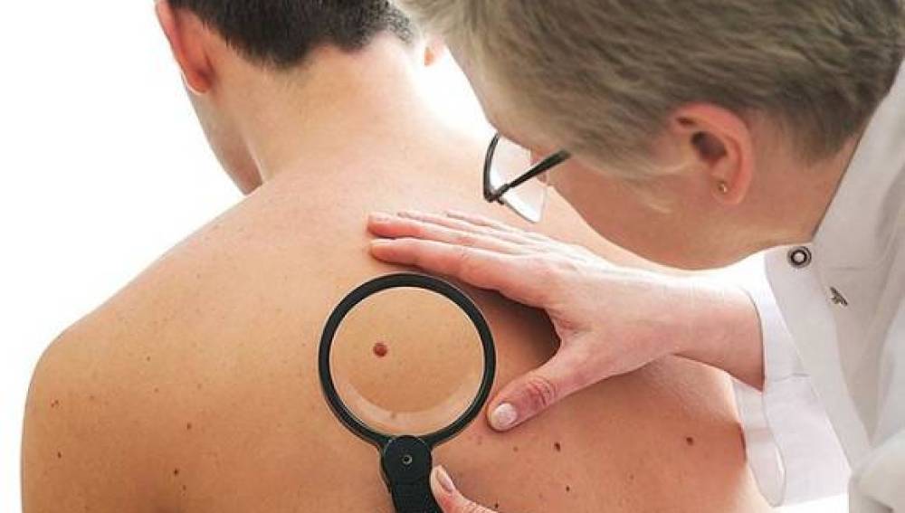 Uno de cada cinco pacientes habrá desarrollado cáncer de piel al llegar a los 70 años