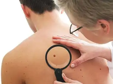 Uno de cada cinco pacientes habrá desarrollado cáncer de piel al llegar a los 70 años Uno de cada cinco pacientes habrá desarrollado cáncer de piel al llegar a los 70 años