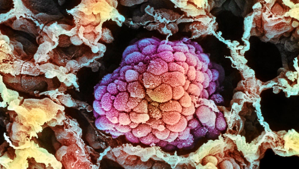 Imagen microscópica de un tumor durante su proceso de expansión 