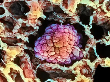 Imagen microscópica de un tumor durante su proceso de expansión Imagen microscópica de un tumor durante su proceso de expansión