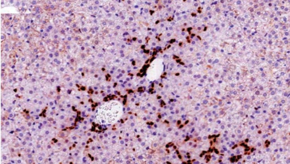 Sección del hígado de un modelo de ratón en el que los hepatocitos expresan el oncogen URI. La imagen muestra la expansión de las células madre del hígado, llamada “reacción ductal”, en los primeros compases de la formación de un tumor