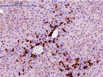 Sección del hígado de un modelo de ratón en el que los hepatocitos expresan el oncogen URI. La imagen muestra la expansión de las células madre del hígado, llamada “reacción ductal”, en los primeros compases de la formación de un tumor Sección del hígado de un modelo de ratón en el que los hepatocitos expresan el oncogen URI. La imagen muestra la expansión de las células madre del hígado, llamada “reacción ductal”, en los primeros compases de la formación de un tumor