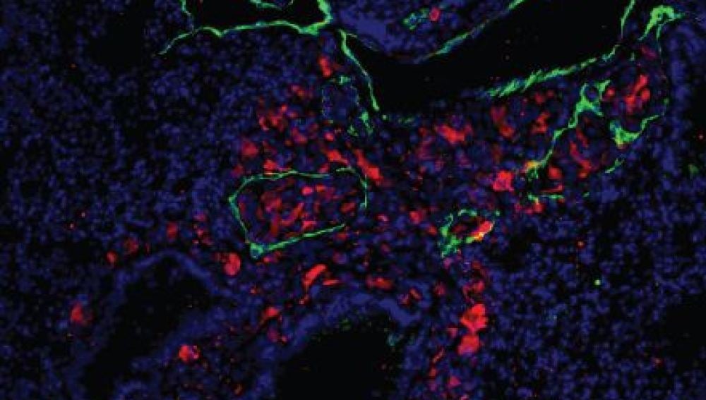 Células de melanoma metastásico (rojo) en vasos linfáticos en pulmón (verde)