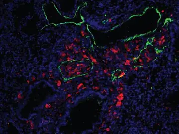 Células de melanoma metastásico (rojo) en vasos linfáticos en pulmón (verde) Células de melanoma metastásico (rojo) en vasos linfáticos en pulmón (verde)