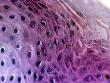 La varicela puede ser mortal por una mutación en el sistema inmunológico La varicela puede ser mortal por una mutación en el sistema inmunológico