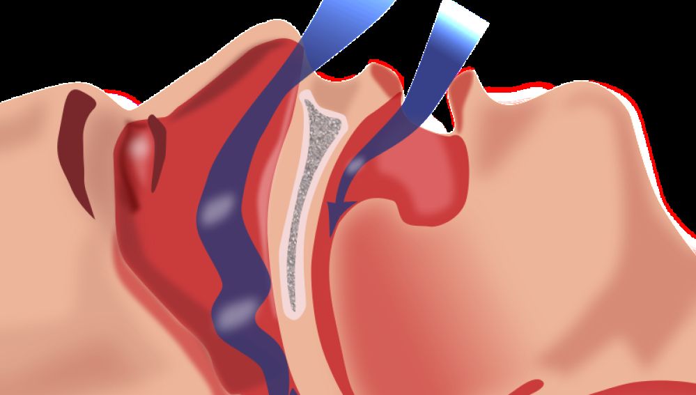 Un sistema portatil para detectar apnea del sueno en pacientes con EPOC
