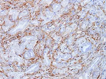 Células tumorales de cáncer de páncreas del modelo Kras del CNIO Células tumorales de cáncer de páncreas del modelo Kras del CNIO