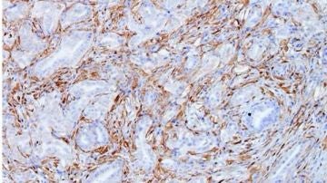 Células tumorales de cáncer de páncreas del modelo Kras del CNIO Células tumorales de cáncer de páncreas del modelo Kras del CNIO