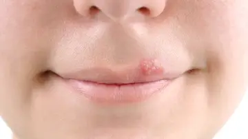 Aparición de una calentura o herpes labial Aparición de una calentura o herpes labial