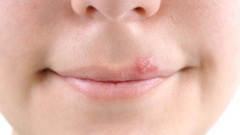 Aparición de una calentura o herpes labial