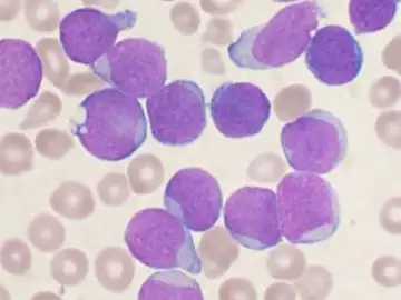 leucemia linfoide aguda leucemia linfoide aguda