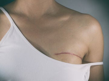 Cicatriz en la mama