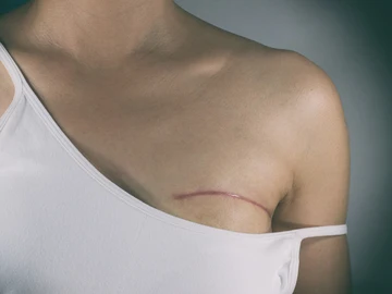 Cicatriz en la mama