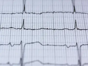 Electrocardiograma Electrocardiograma