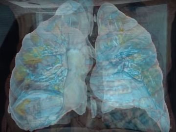 Imagen de unos pulmones afectados por coronavirus (Archivo)