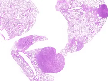 Tumor pulmonar inducido por KRAS4A Tumor pulmonar inducido por KRAS4A