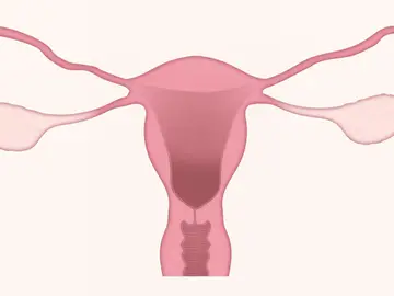 Cáncer de cérvix Cáncer de cérvix