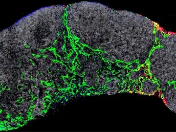 Nuevo avance contra el cáncer: Investigadores españoles descubren una forma de frenar la metástasis del melanoma Nuevo avance contra el cáncer: Investigadores españoles descubren una forma de frenar la metástasis del melanoma